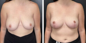 before and after breast reduction front view case 1286