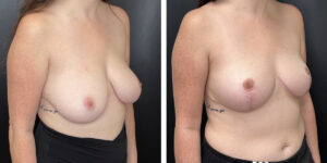 before and after breast reduction right angled view case 1286