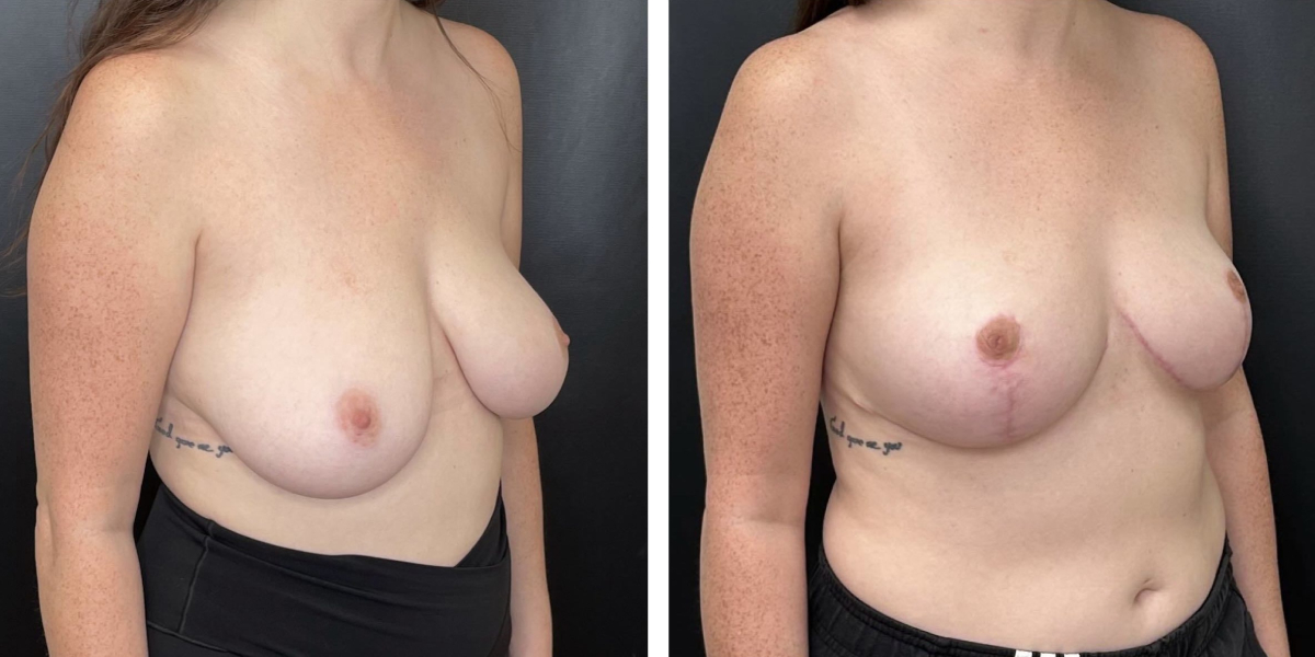 before and after breast reduction right angled view case 1286