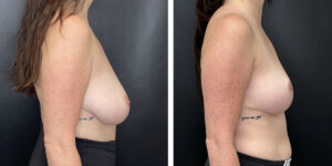 before and after breast reduction right side view case 1286