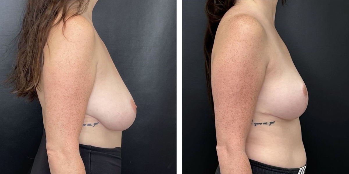 before and after breast reduction right side view case 1286