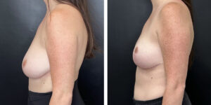 before and after breast reduction left side view case 1286