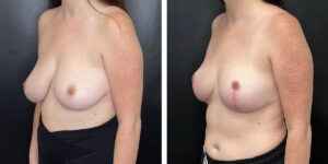 before and after breast reduction left angled view case 1286