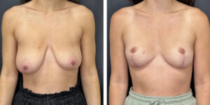 before and after breast reduction front view case 1292