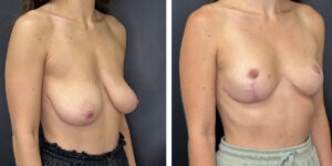 before and after breast reduction right angled view case 1292