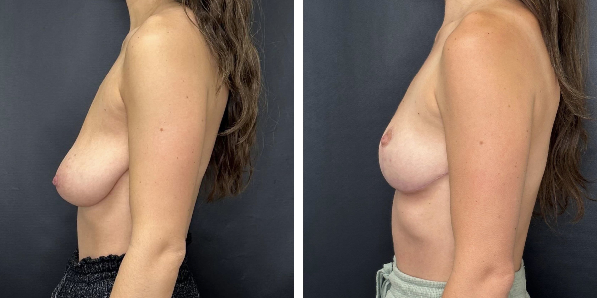 before and after breast reduction left side view case 1292