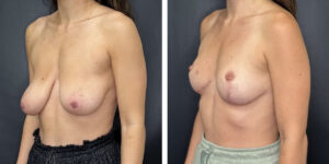 before and after breast reduction left angled view case 1292