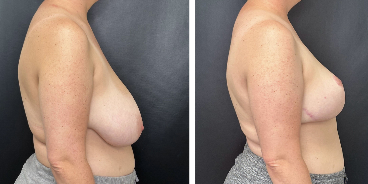 before and after breast reduction right side view case 1298