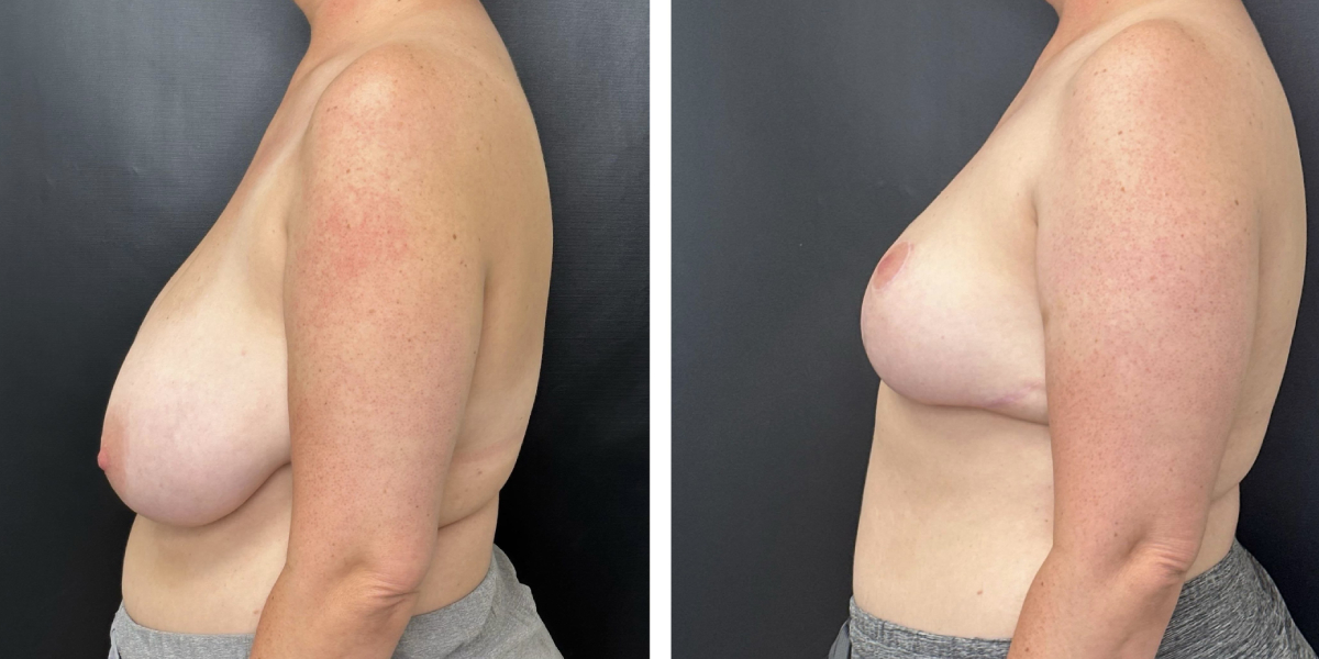 before and after breast reduction left side view case 1298