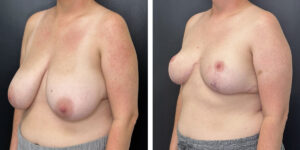 before and after breast reduction left angled view case 1298