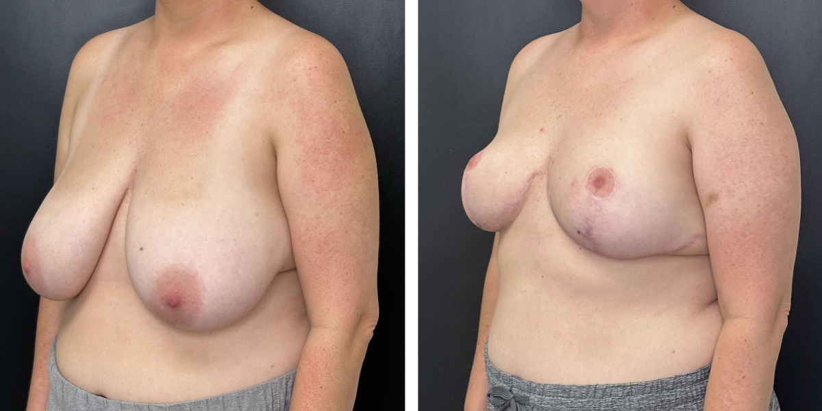 before and after breast reduction left angled view case 1298