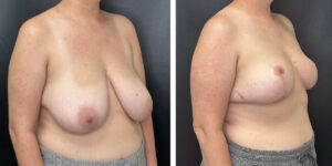before and after breast reduction right angled view case 1298