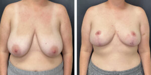 before and after breast reduction front view case 1298