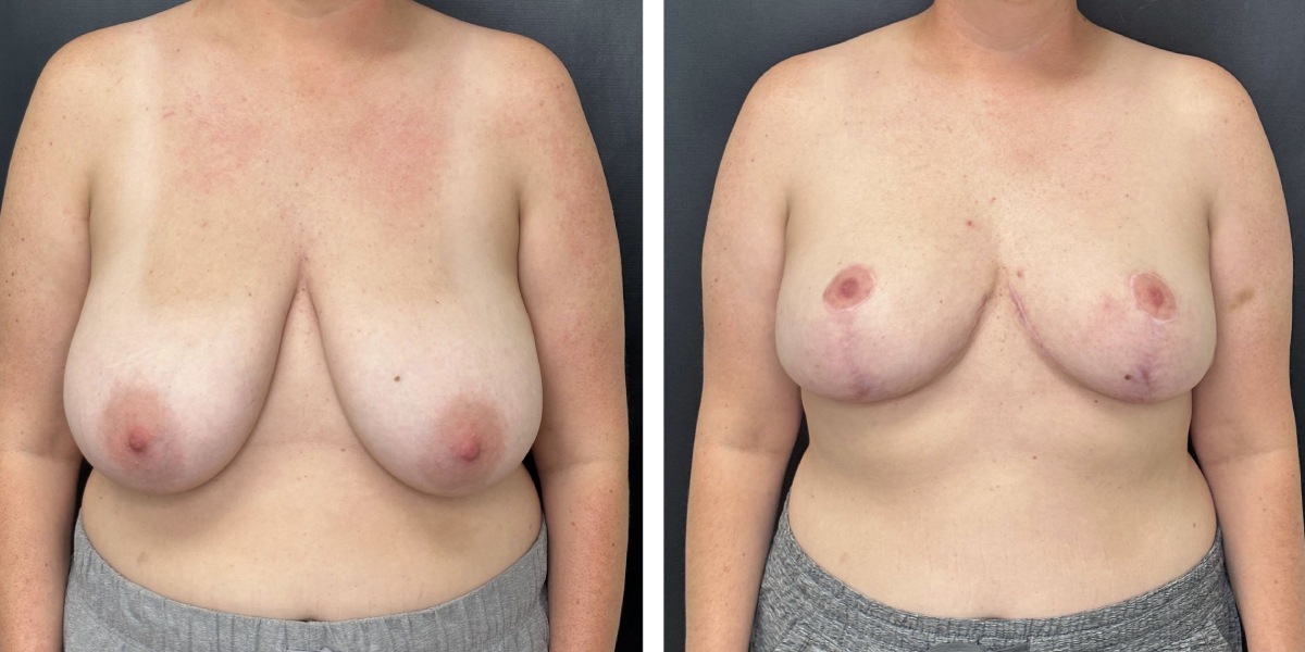 before and after breast reduction front view case 1298