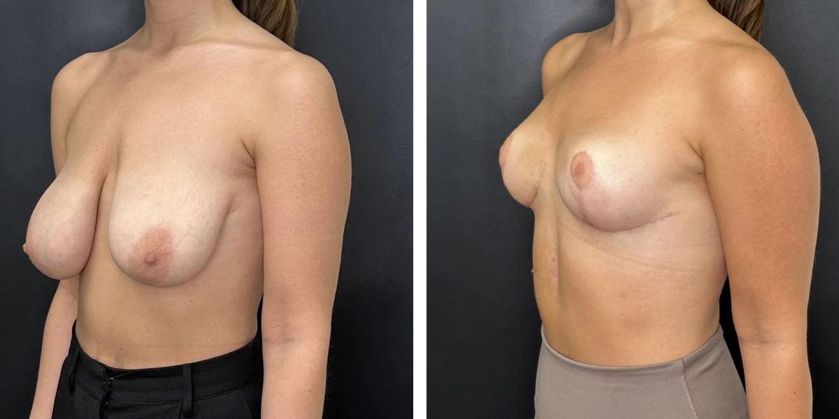 before and after breast reduction left angled view case 1304