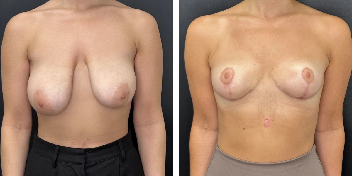 before and after breast reduction front view case 1304