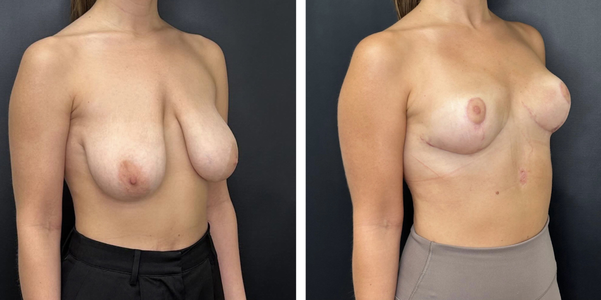 before and after breast reduction right angled view case 1304