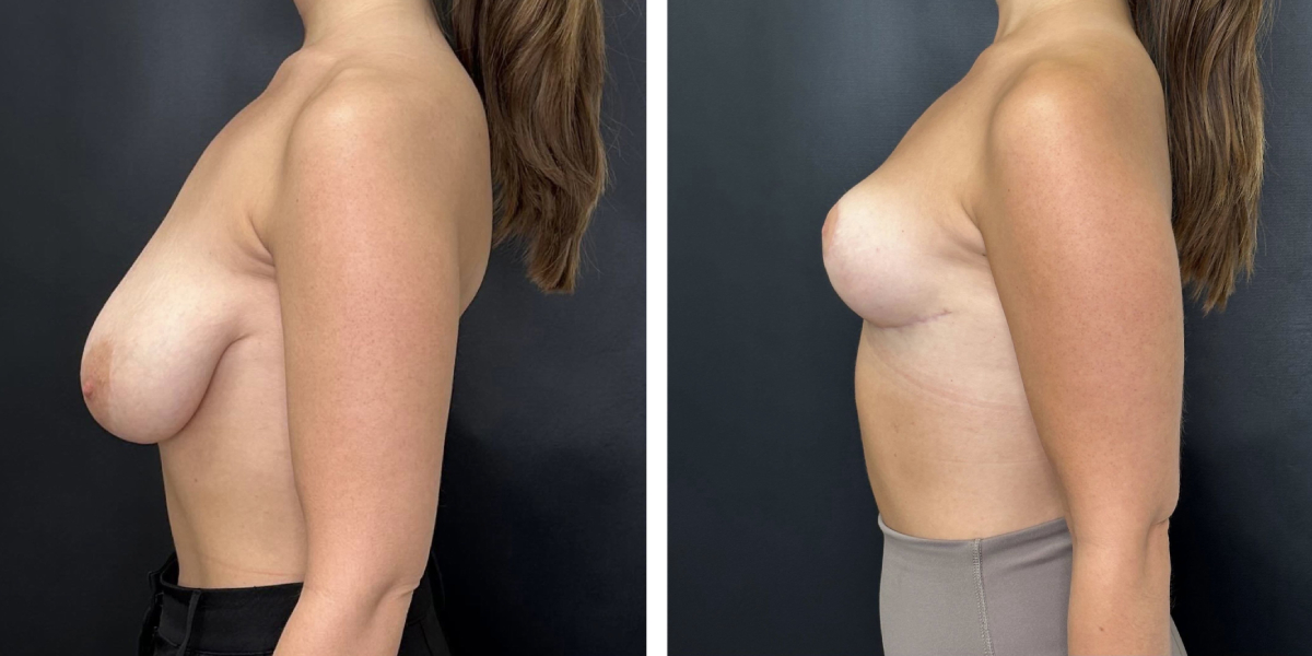 before and after breast reduction left side view case 1304