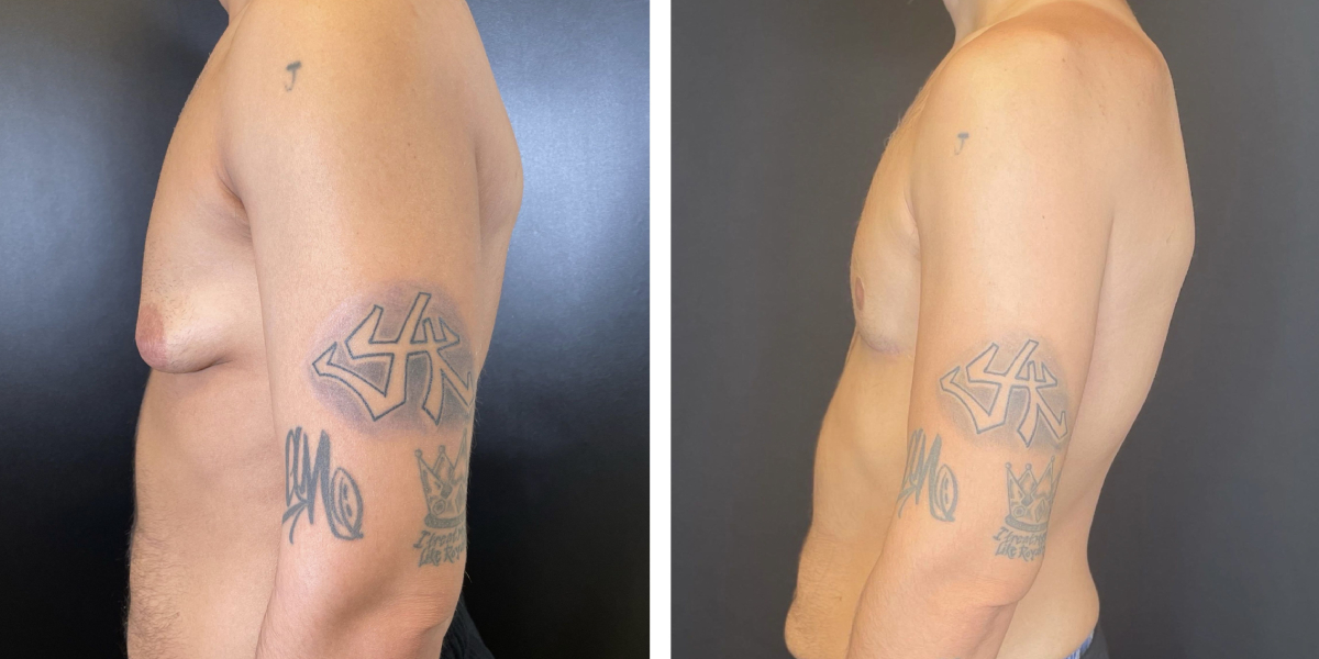 before and after gynecomastia left side view male patient case 1423