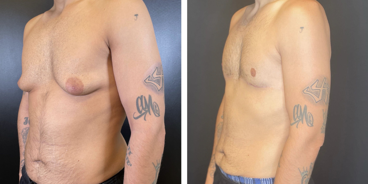 before and after gynecomastia left angled view male patient case 1423
