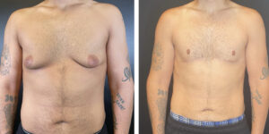 before and after gynecomastia front view male patient case 1423