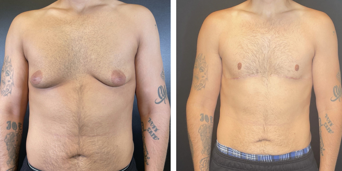 before and after gynecomastia front view male patient case 1423