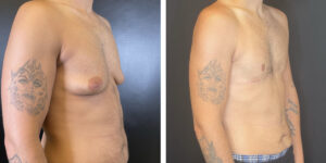 before and after gynecomastia right angled view male patient case 1423