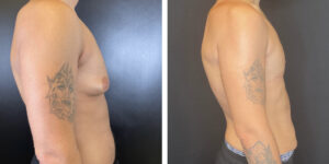 before and after gynecomastia right side view male patient case 1423
