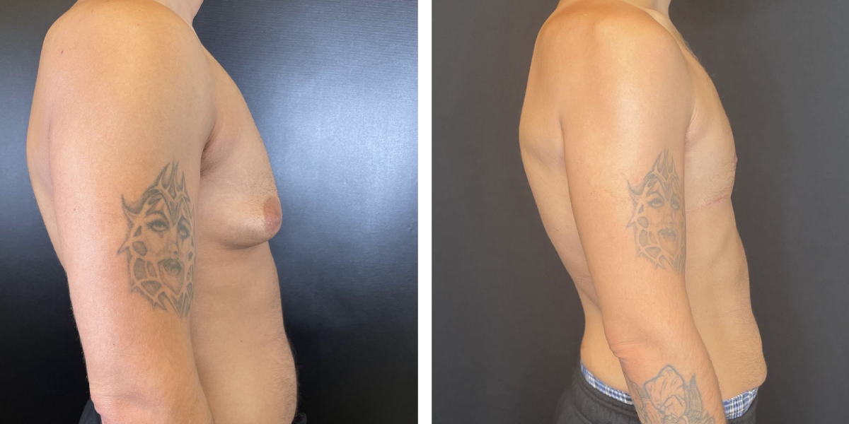before and after gynecomastia right side view male patient case 1423