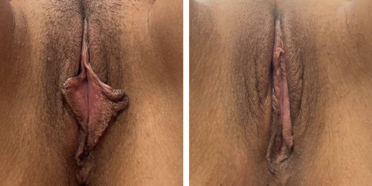 before and after labiaplasty front view case 1857