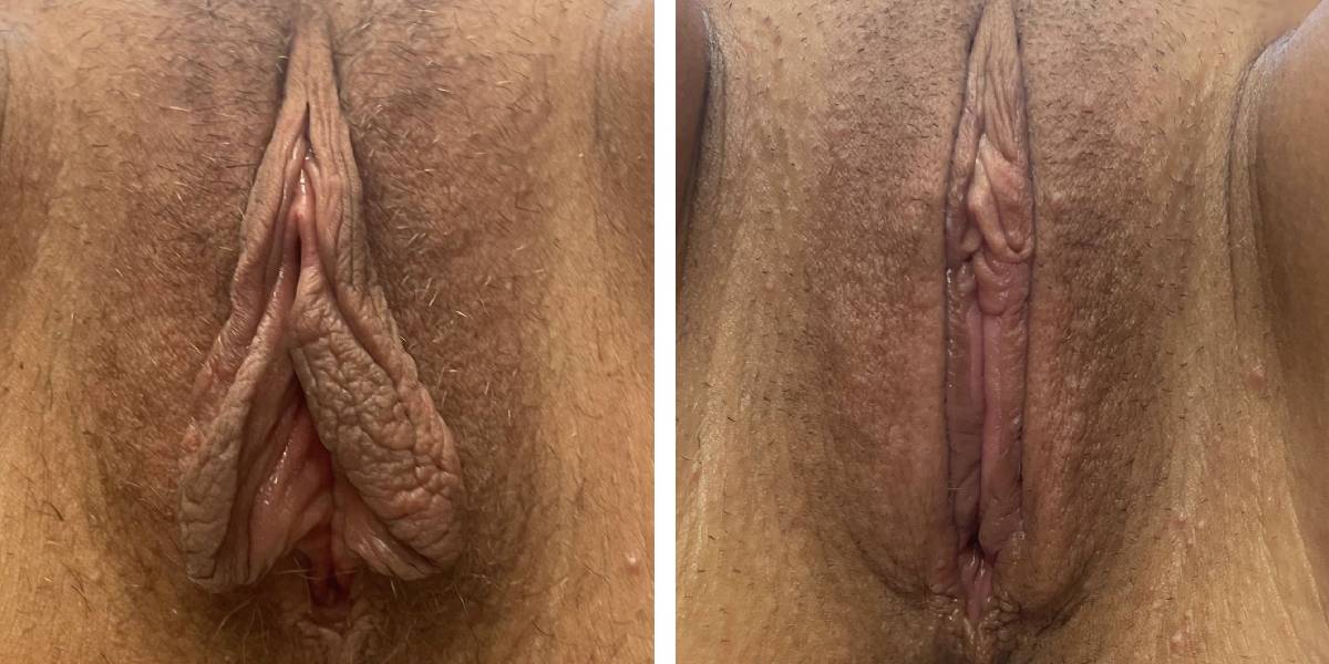 before and after labiaplasty front view case 1859