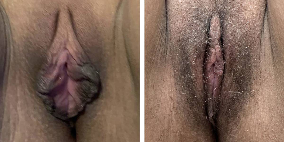 before and after labiaplasty front view case 1862