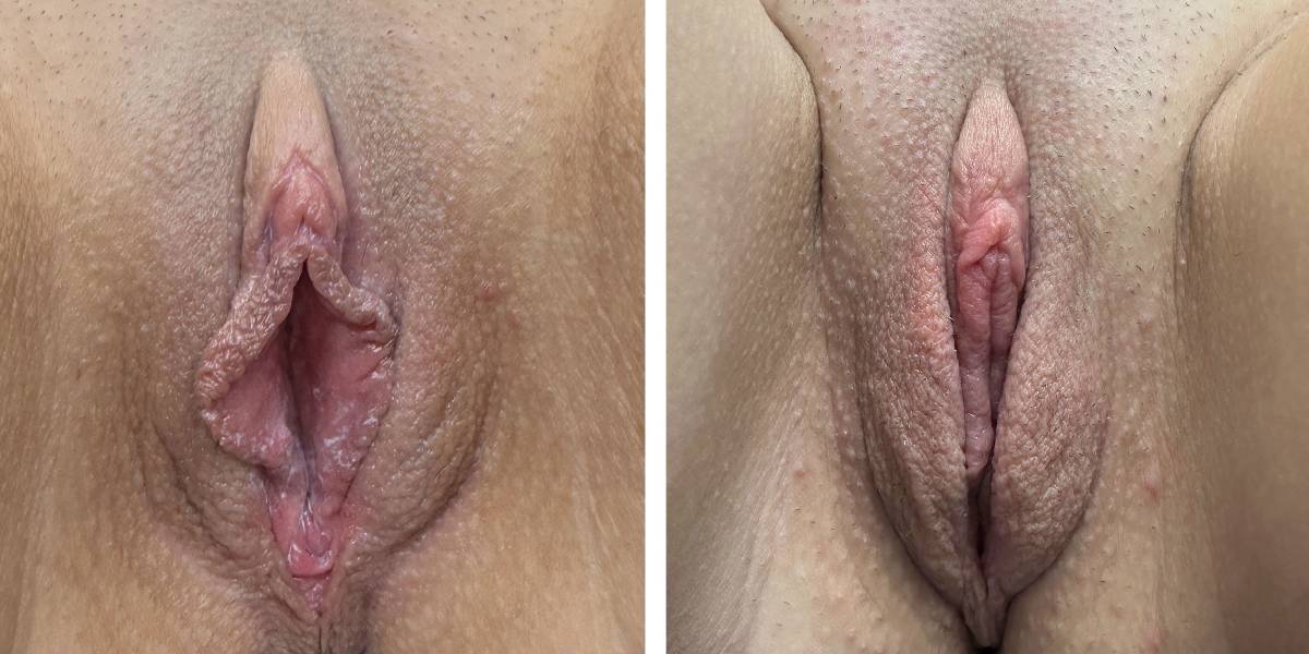 before and after labiaplasty front view case 1864