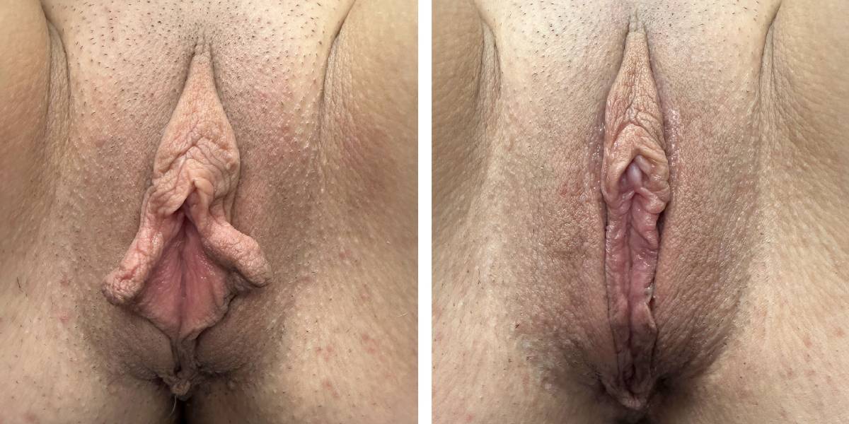 before and after labiaplasty front view case 1866