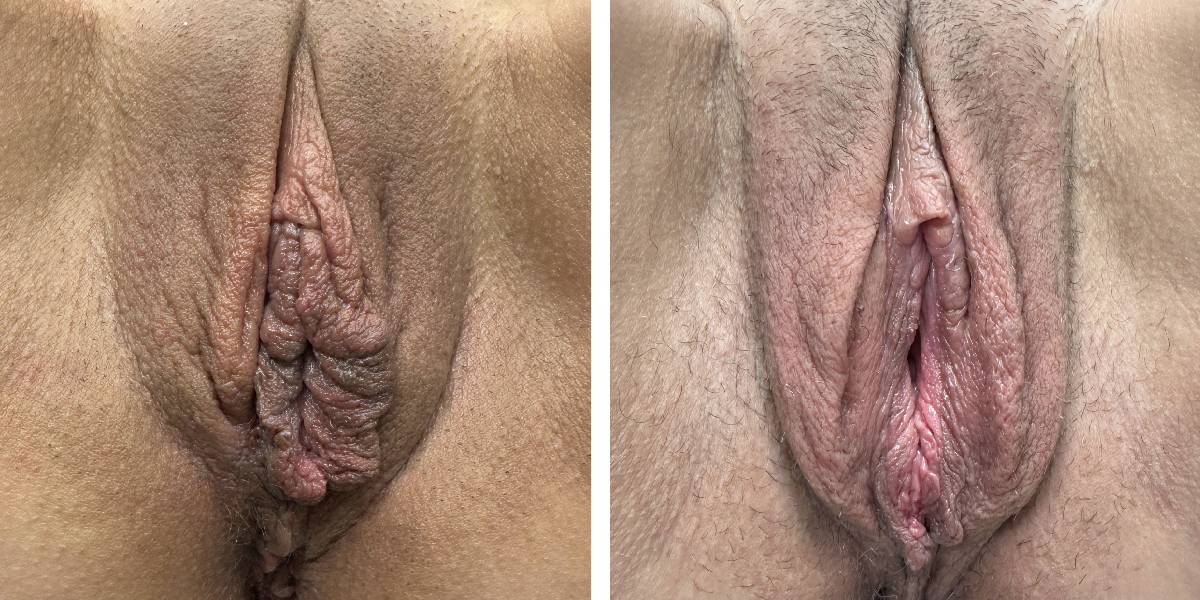 before and after labiaplasty front view case 1868