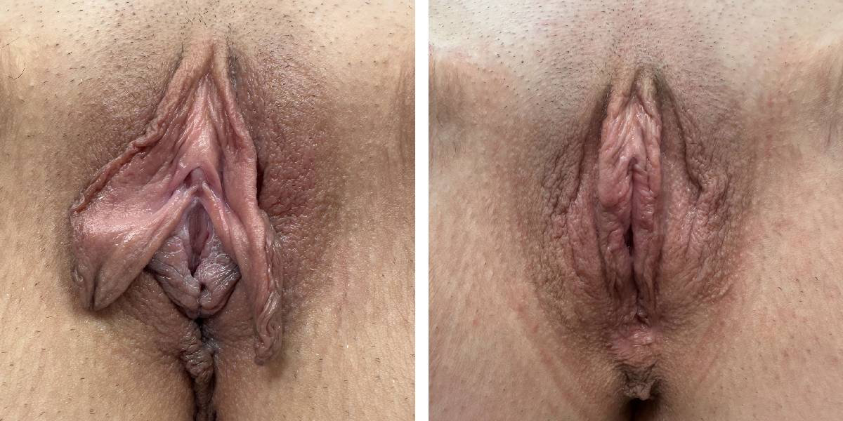 before and after labiaplasty front view case 1870