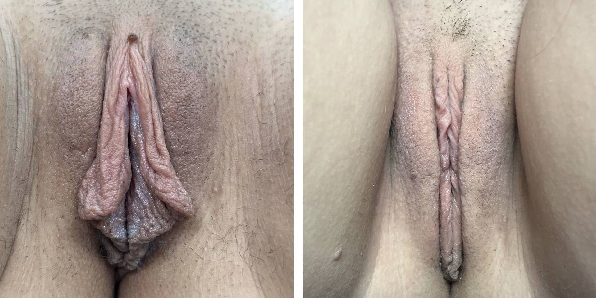before and after labiaplasty front view case 1880