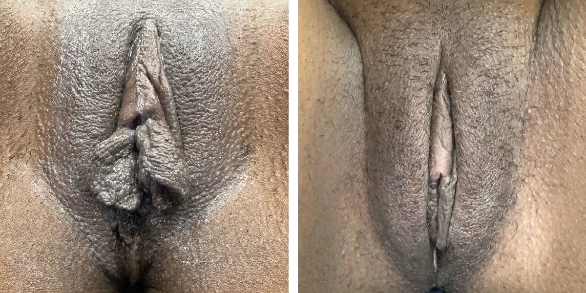 before and after labiaplasty front view of labia case 1883