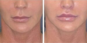 before and after lip lift female patient front view case 1786