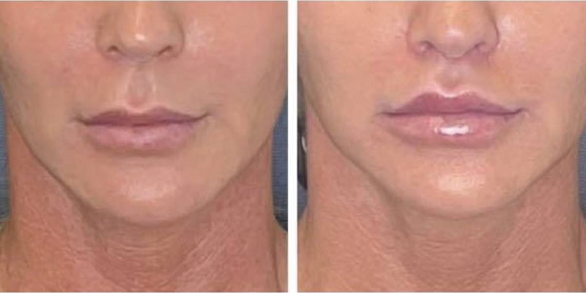 before and after lip lift female patient front view case 1786