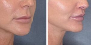 before and after lip lift female patient right angled view case 1786