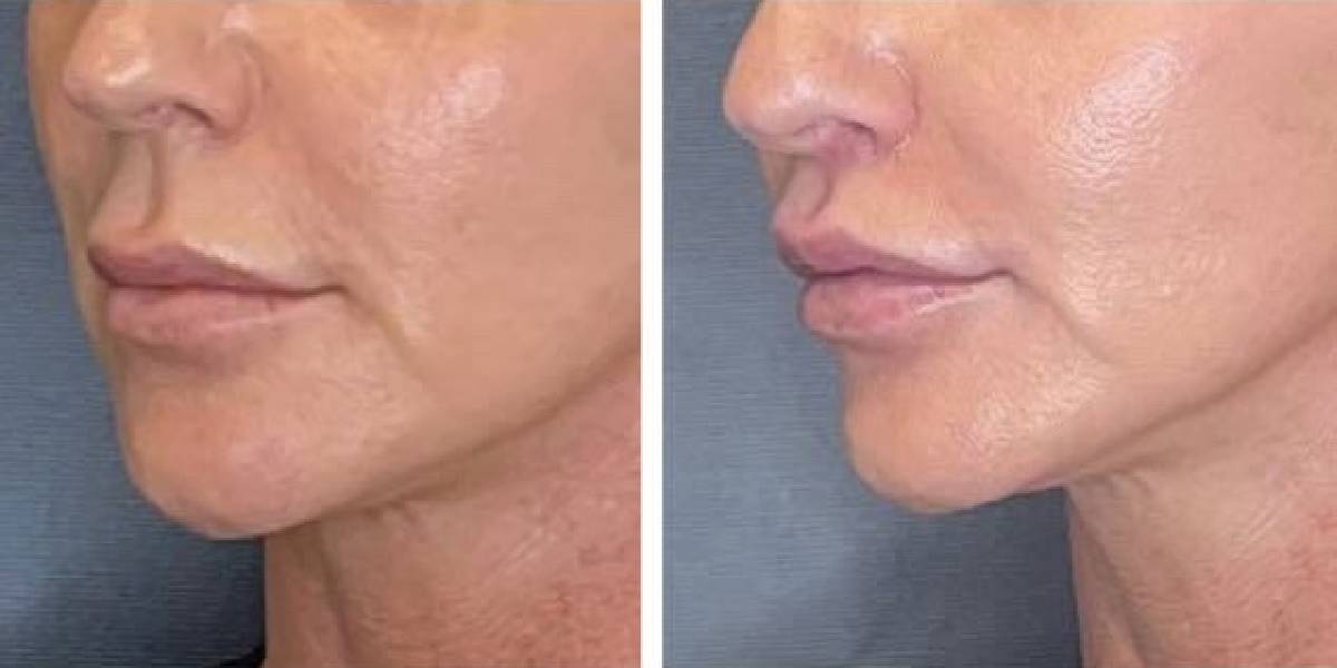 before and after lip lift female patient left angled view case 1786