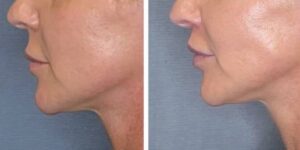 before and after lip lift female patient left side view case 1786