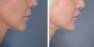 before and after lip lift female patient right side view case 1786