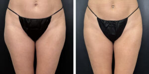 before and after liposuction front view female patient case 1645