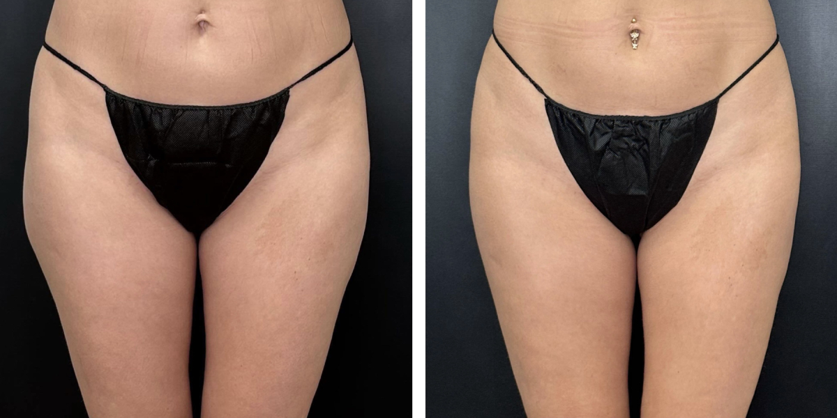 before and after liposuction front view female patient case 1645