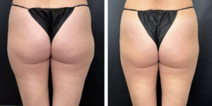 before and after liposuction back view female patient case 1645