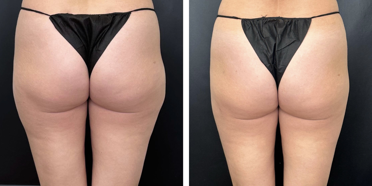 before and after liposuction back view female patient case 1645