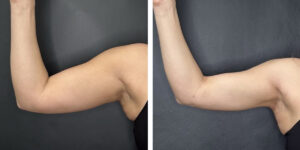 before and after arm liposuction right arm front view female patient case 1649