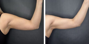 before and after arm liposuction left arm front view female patient case 1649